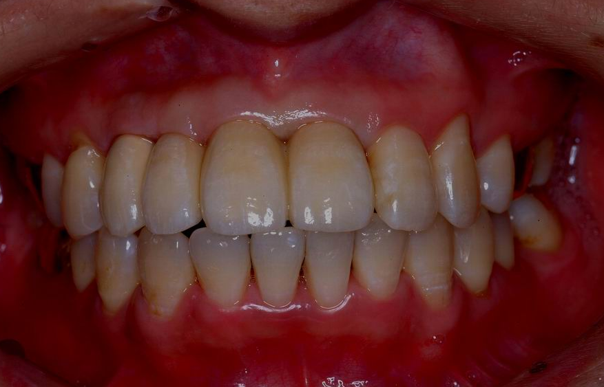 Custom Implant Bridge